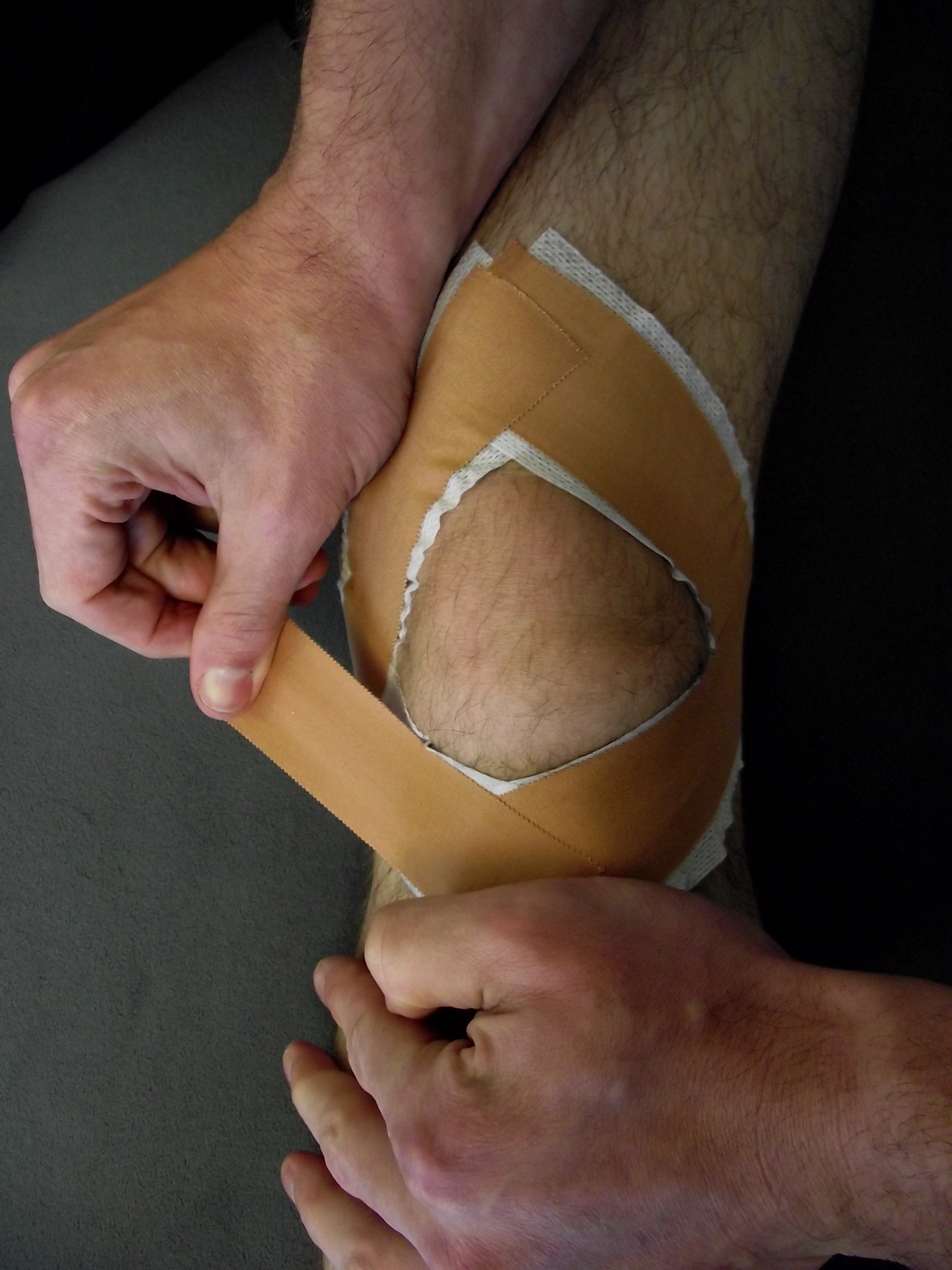 Diamond Patella tape